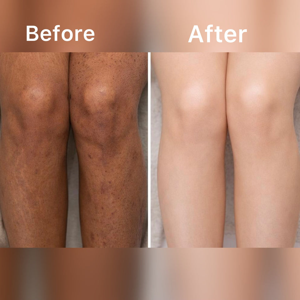 SCRUBUCCINO "Best For Acne, Stretch Marks & Dark Spots"