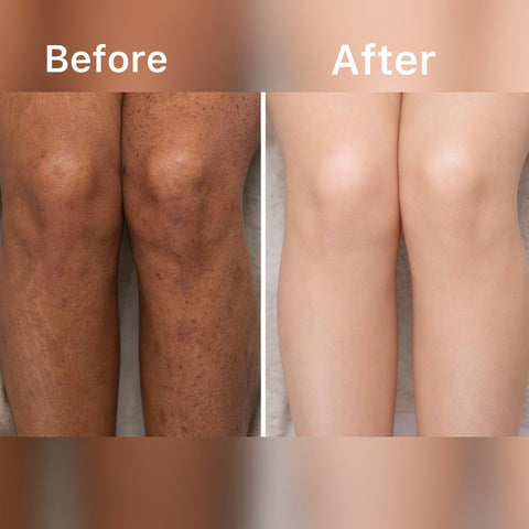 SCRUBUCCINO "Best For Acne, Stretch Marks & Dark Spots"
